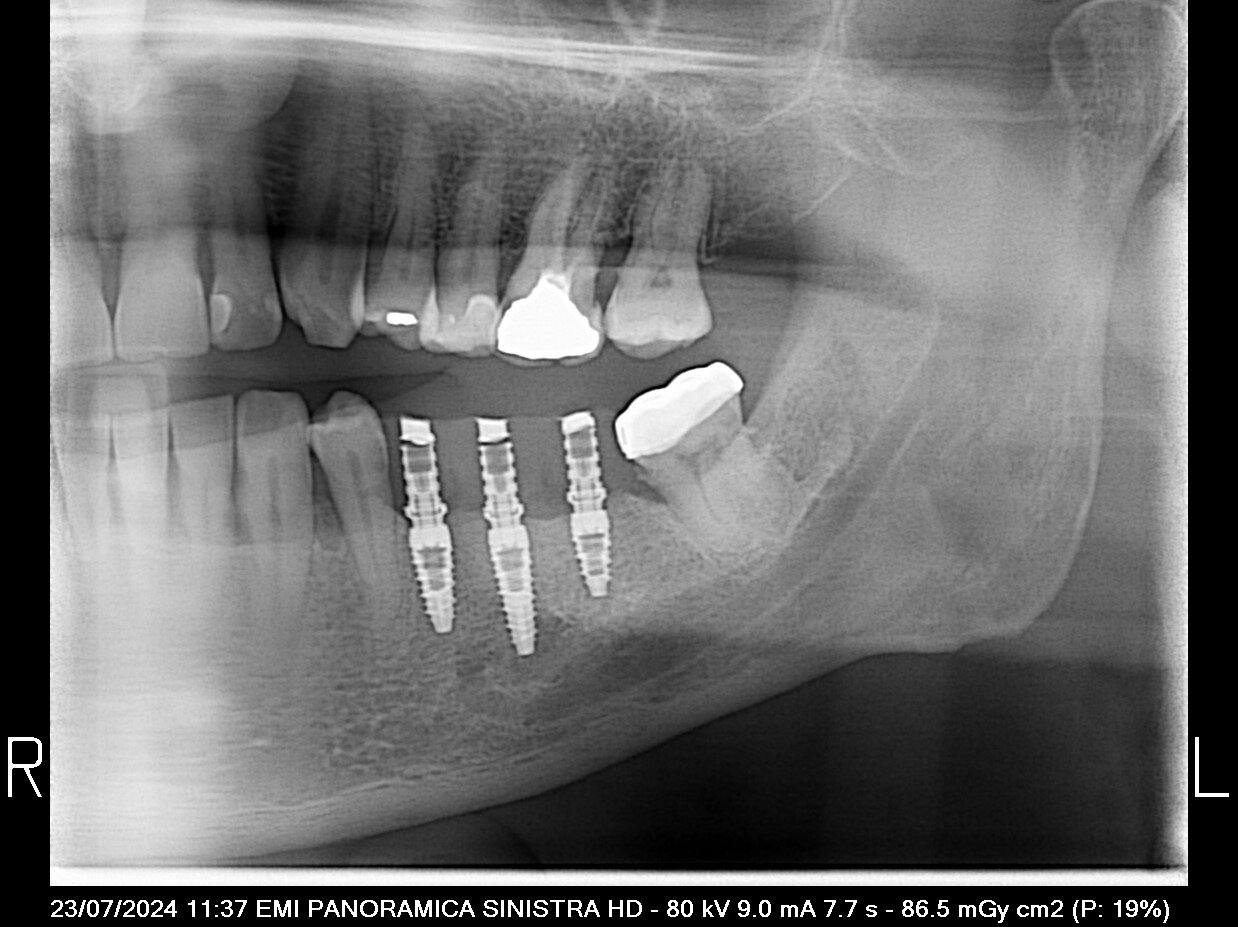3 impianti insetiti Radiografia panoramica di caso eseguito con inserimento di 3 impianti e contestuale montaggio ponte avvitato.