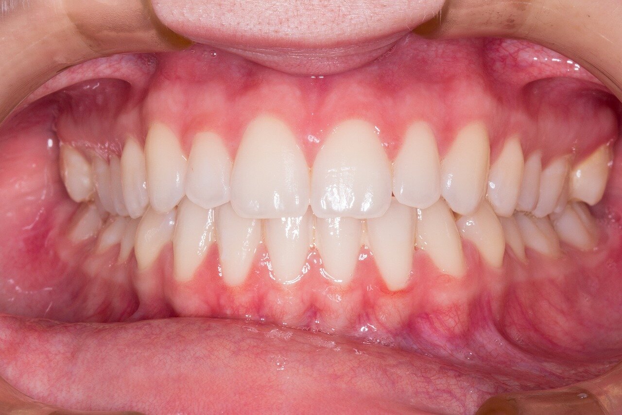 Sorriso Sano di denti e gengive Immagine di una bocca sana dal punto di vista gengivale e dentale.